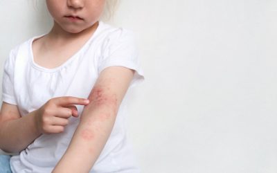 Atopijski dermatitis – kada se koža upali