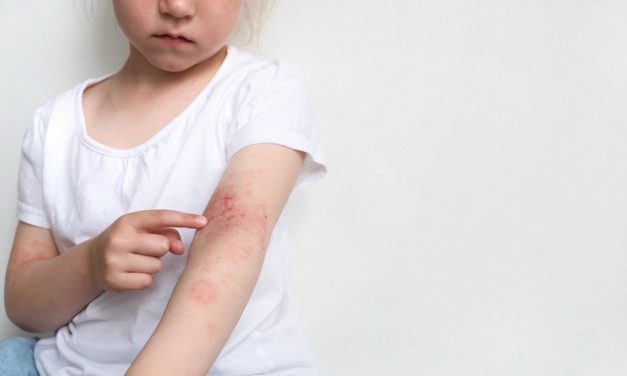 Atopijski dermatitis – kada se koža upali