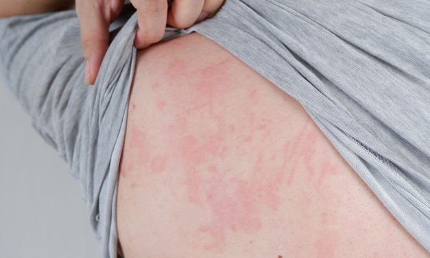 Šuga se širi po Crnoj Gori: Najviše obolelih u Podgorici