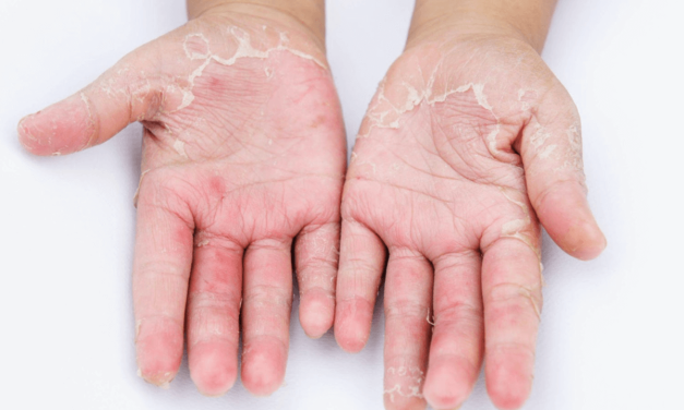 Prevencija i svakodnevna nega kože kod kontaktnog dermatitisa
