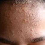 Kada komedoni na licu zahtevaju stručnu procenu i profesionalni pristup