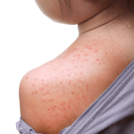 Osip nakon temperature kod djece: što može značiti