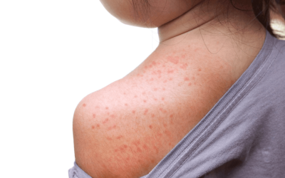 Osip nakon temperature kod djece: što može značiti